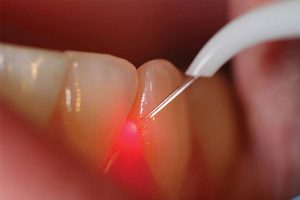 Holistische parodontologie - laser