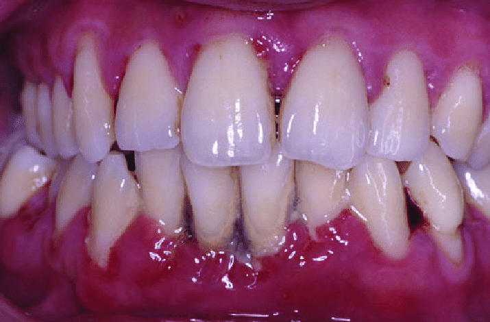 Gevorderde parodontitis